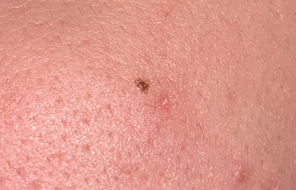 Ist dieses Muttermal auffällig /? (Hautkrebs, melanom) Ist dieses Muttermal auffällig /? (Hautkrebs, melanom)