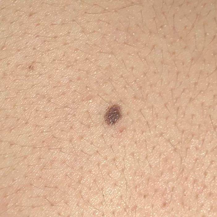 Ist dieses schwarze Muttermal Hautkrebs? (Gesundheit und Medizin)