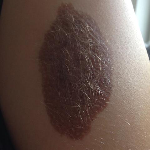 ist ein grosses muttermal abstossend