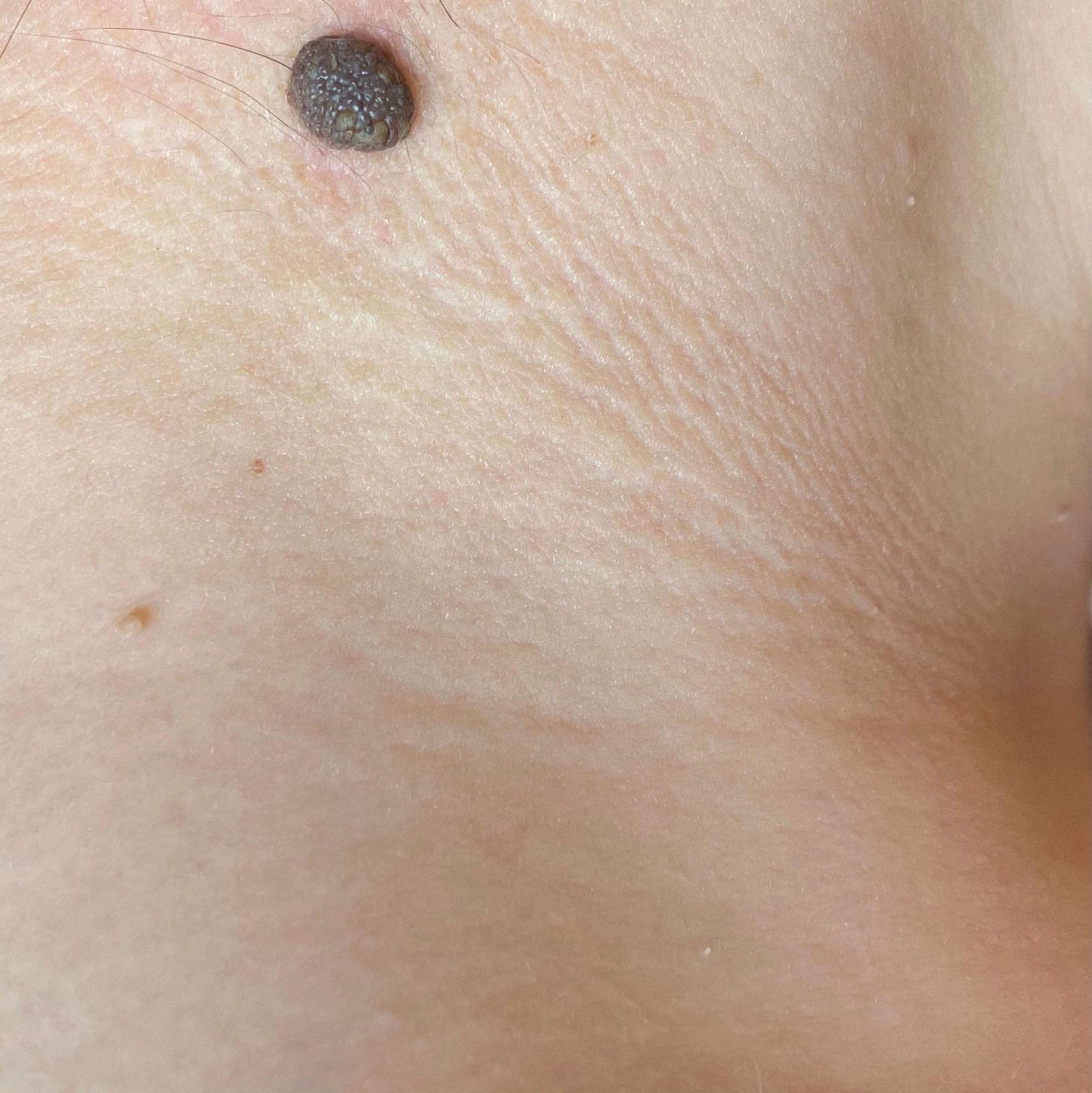 Ist ein solches Muttermal immer bösartig? (Gesundheit und Medizin, Haut)