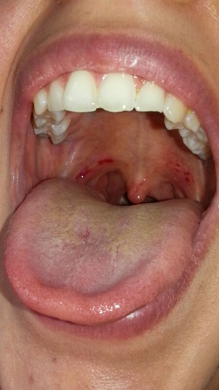 Ist eine gelbe Zunge schlimm? (Gesundheit, Medizin)