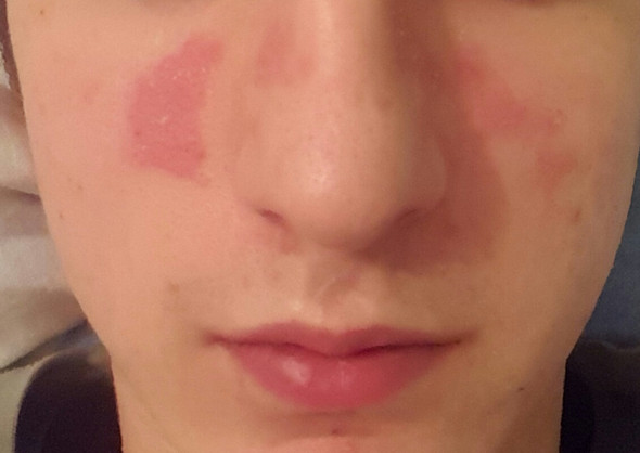 Ist Eine Rotung Im Gesicht Nach Dem Krank Sein Nomal Und Wie Wird Man Sie Am Schnellsten Los Danke Fieber Asthma