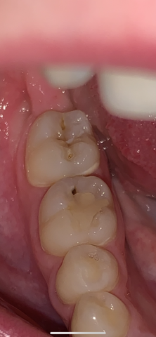 Provisorische füllung wurzelbehandlung Endodontie