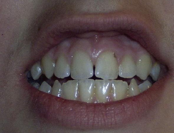 Zähne mit Fehlstellung? - (Medizin, Arzt, Zähne)