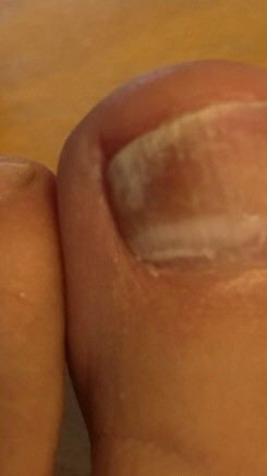 Ist Es Ein Nagelpilz Am Grossen Zeh Gesundheit Grosser Zeh Ist Es Ein Nagelpilz Am Grossen Zeh Gesundheit Grosser Zeh