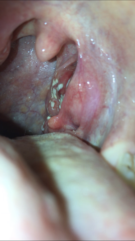 Ist Es Eine Bakterielle Mandelentzundung Gesundheit Und Medizin Ist Es Eine Bakterielle Mandelentzundung Gesundheit Und Medizin