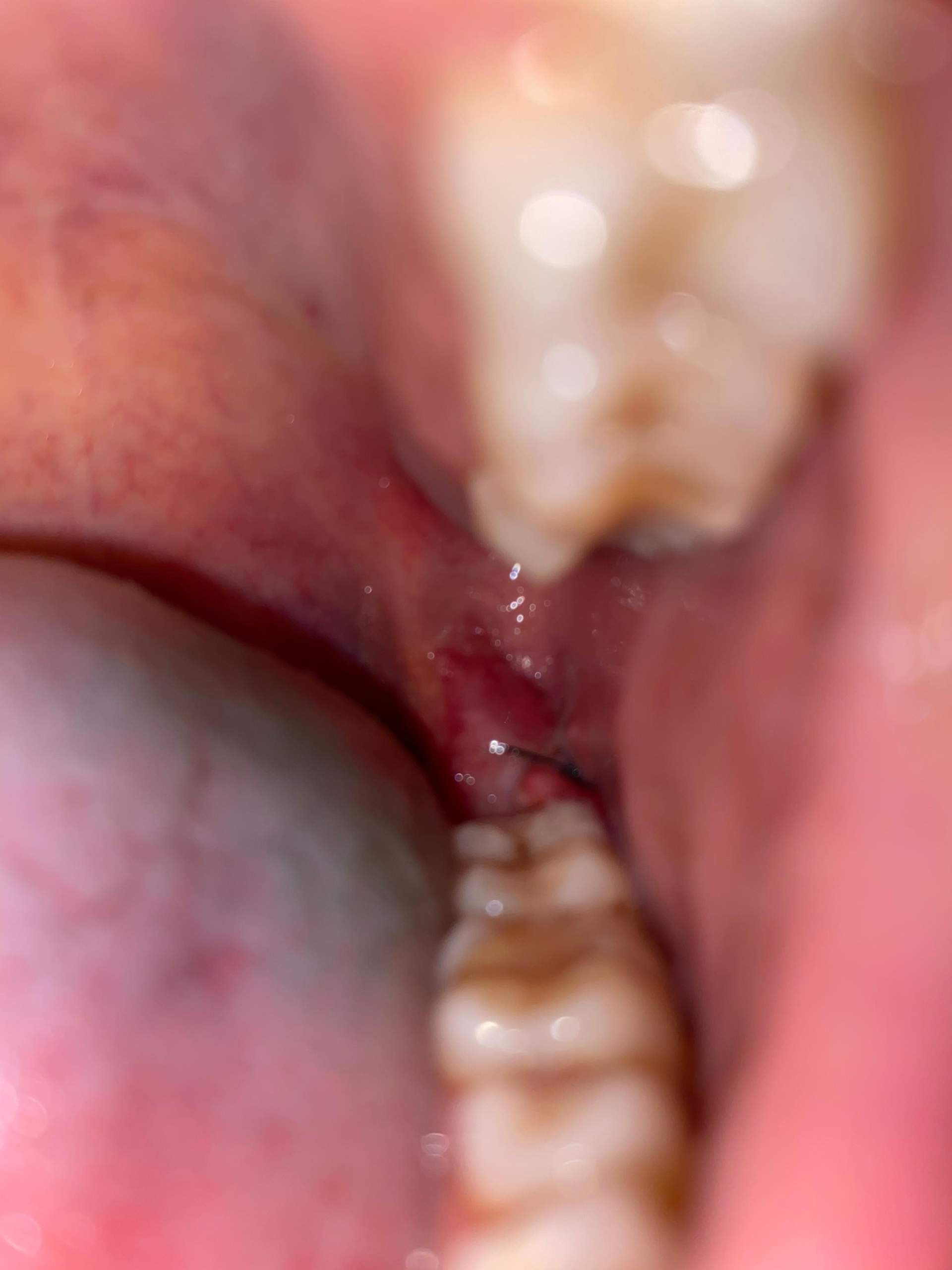Nach Weisheitszahn Op Vapen Ist es Entzndet (Weisheitszahn OP)? (Gesundheit und Medizin, Zhne, Weisheitszhne) Nach Weisheitszahn Op Vapen Ist es Entzndet (Weisheitszahn OP)? (Gesundheit und Medizin, Zhne, Weisheitszhne)