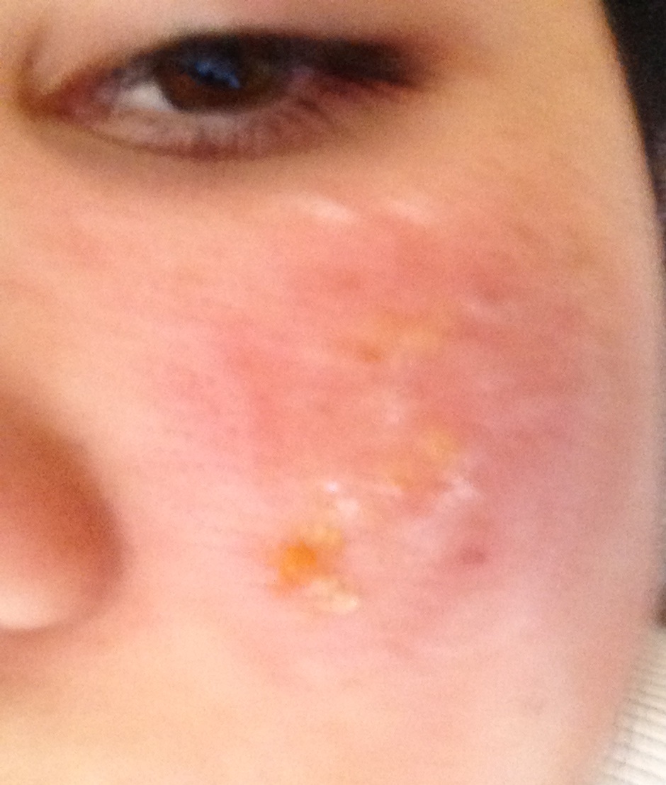 ist es gürtelrose oder was anderes? brauche dringend hilfe! (Medizin ist es gürtelrose oder was anderes? brauche dringend hilfe! (Medizin