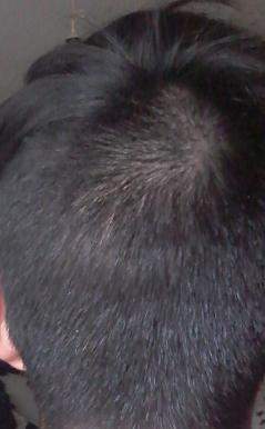 ist es haarausfall oder nur der wirbel