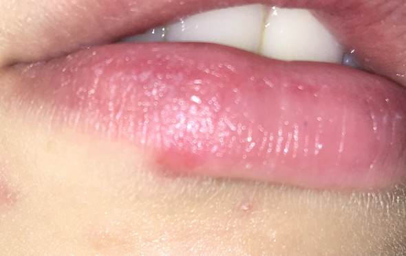 wie lange dauert es bis herpes weg ist