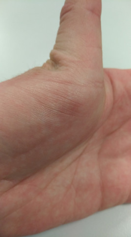Ist Es Normal Das Ich Meinen Daumen So Weit Nach Hinten Knicken Kann Gesundheit Menschen Korper Ist Es Normal Das Ich Meinen Daumen So Weit Nach Hinten Knicken Kann Gesundheit Menschen Korper