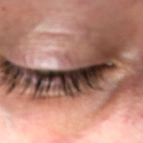 Sehr dünne Haut am Auge, dünne Haut ist ein Zeichen für Eds - (Medizin, Arzt, Haut)