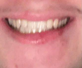 Ist es normal, dass man beim Lächeln das Zahnfleisch sieht?