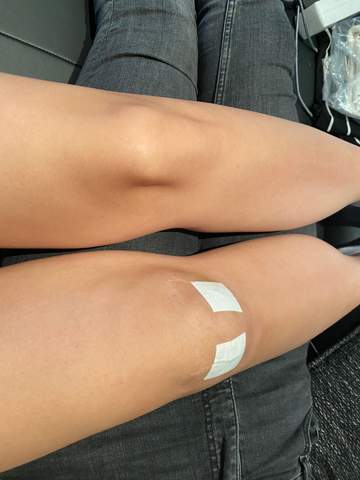 Knie fäden arthroskopie nach ziehen Wunde nach