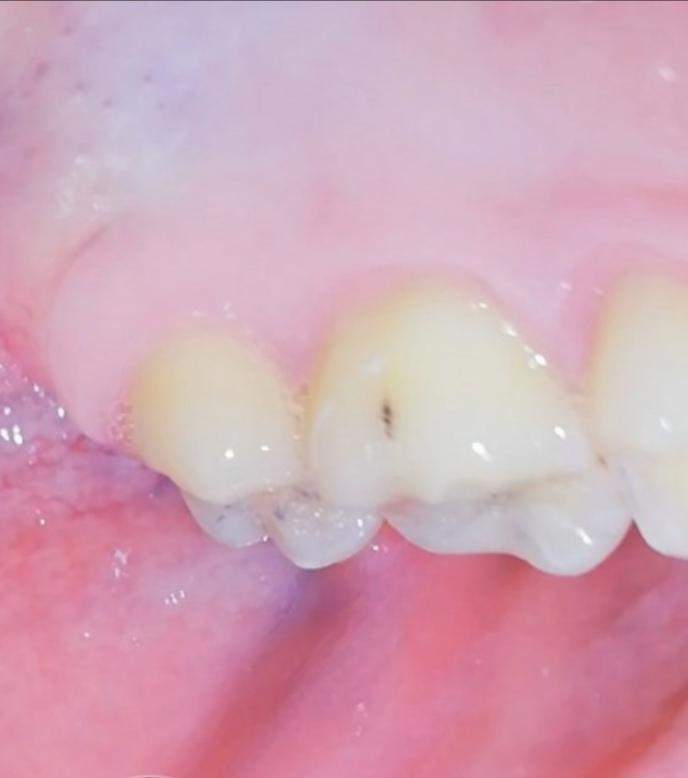 Zahnfüllungen - Keine harmlose Alternative