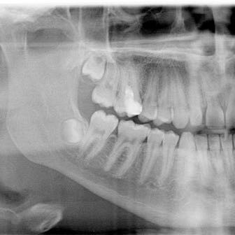 An dem helleren Zahn wurde die behandlung durchgeführt. Bild vom 6. Juli - (Gesundheit und Medizin, Zähne, Zahnarzt)
