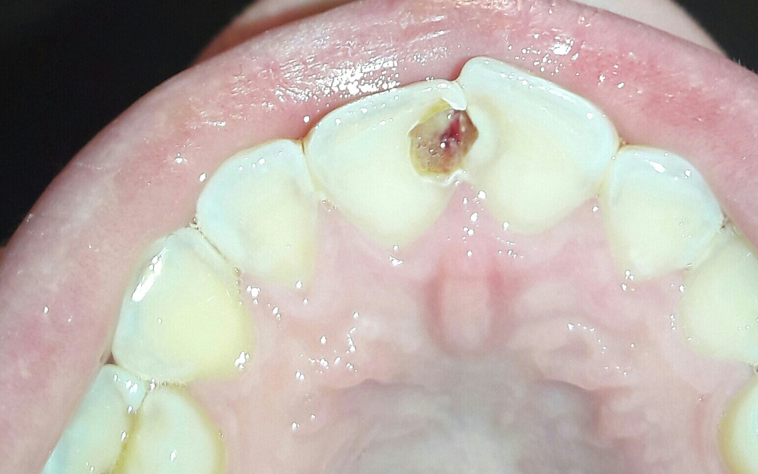 Ist Es Schlimm Wenn Ein Stück Zahn Abbricht Ist es schlimm, wenn eine Zahnfüllung raus fällt? (Angst, Zähne, Zahnarzt)