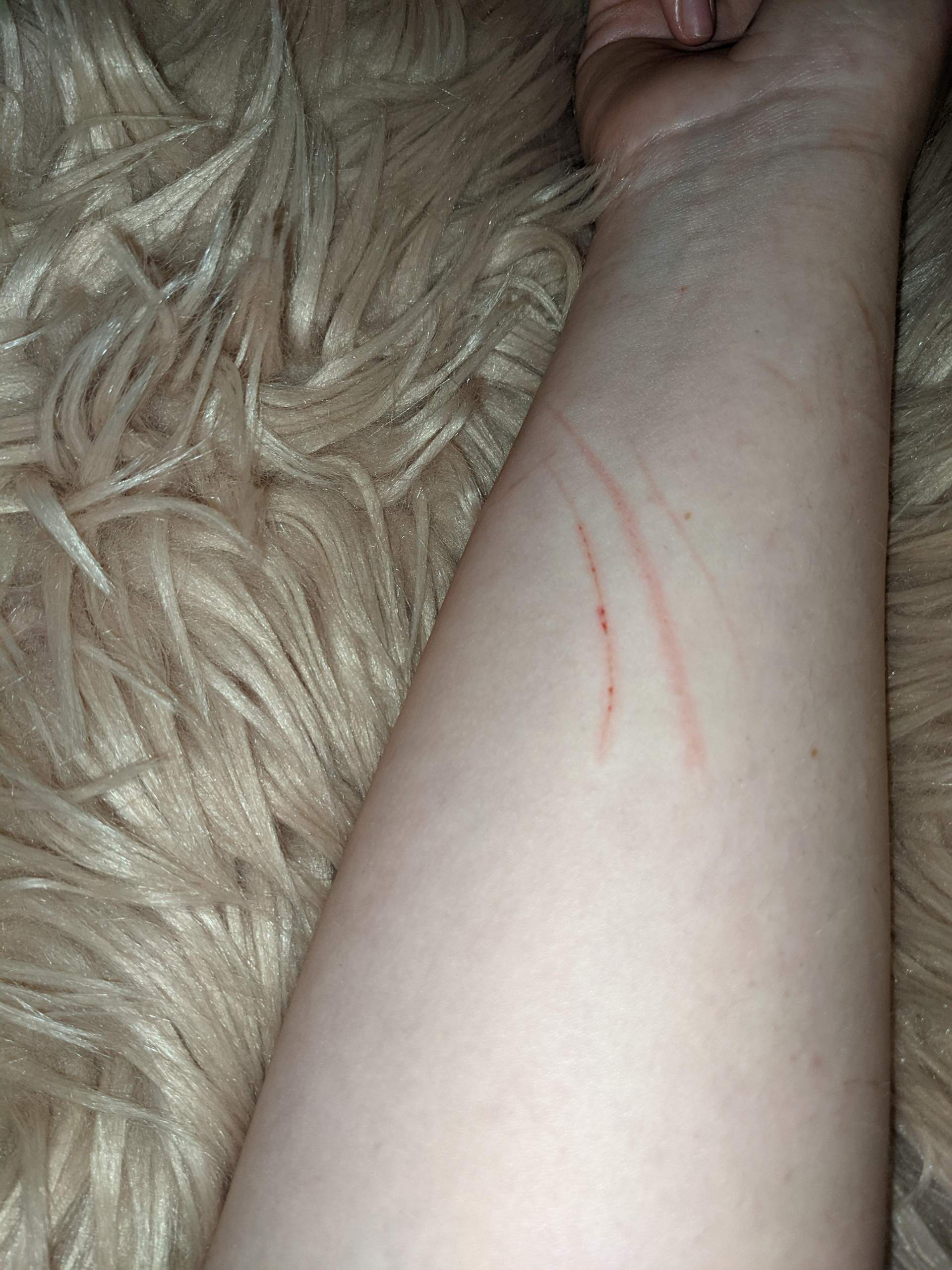 Ist es wahrscheinlich, dass ich Narben bekomme und kann ich der Heilung der Kratzer irgendwie Ist es wahrscheinlich, dass ich Narben bekomme und kann ich der Heilung der Kratzer irgendwie