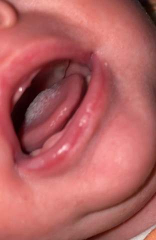 Ist Es Wieder Soor Baby Ist Es Wieder Soor Baby