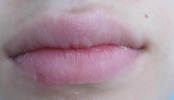 Ist Herpes Im Heilstadium Noch Ansteckend Gesundheit Sexualitat Haut Ist Herpes Im Heilstadium Noch Ansteckend Gesundheit Sexualitat Haut