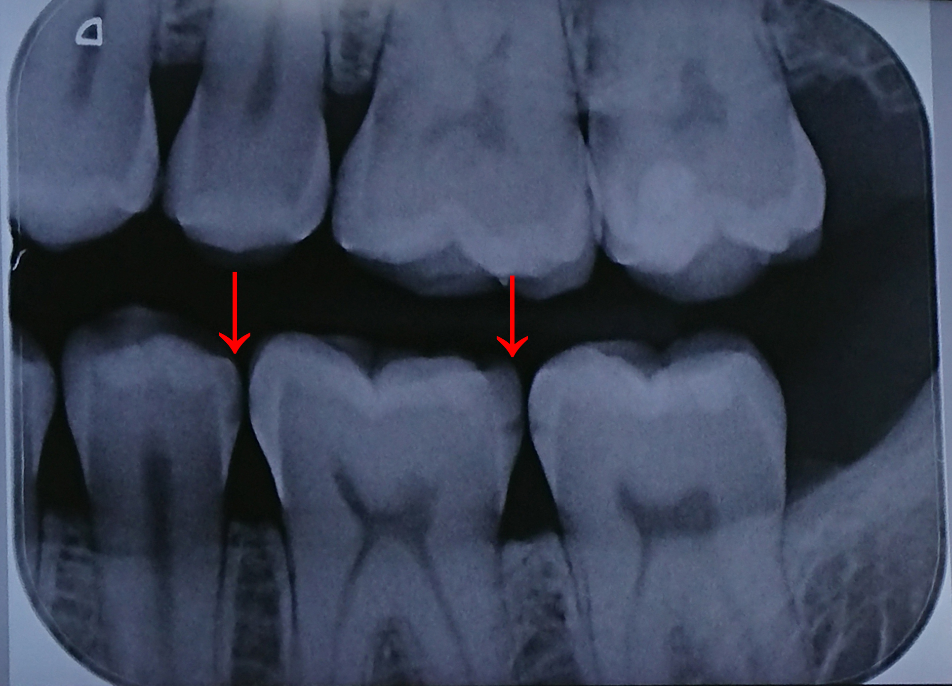 Ist hier eine Zahnfüllung erforderlich (Röntgenbild)? (Zahnarzt, Karies ...