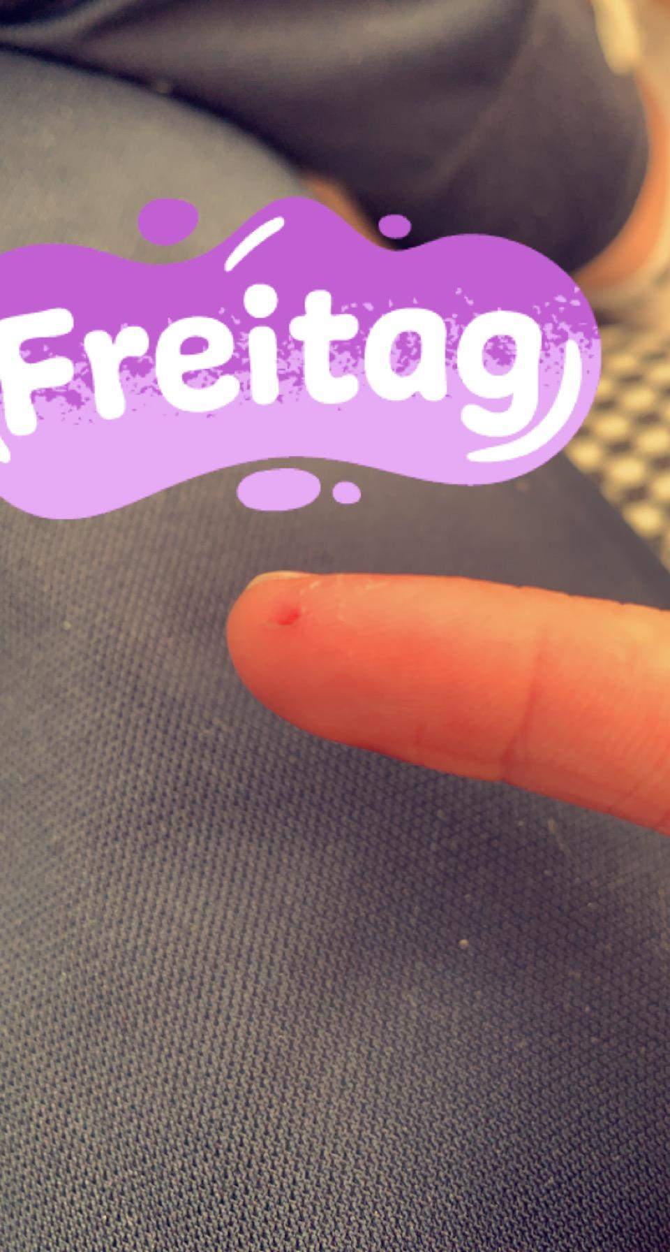 Ist Hiv über kleine Wunden am Finger übertragbar? (Gesundheit und Medizin, HIVInfektion)