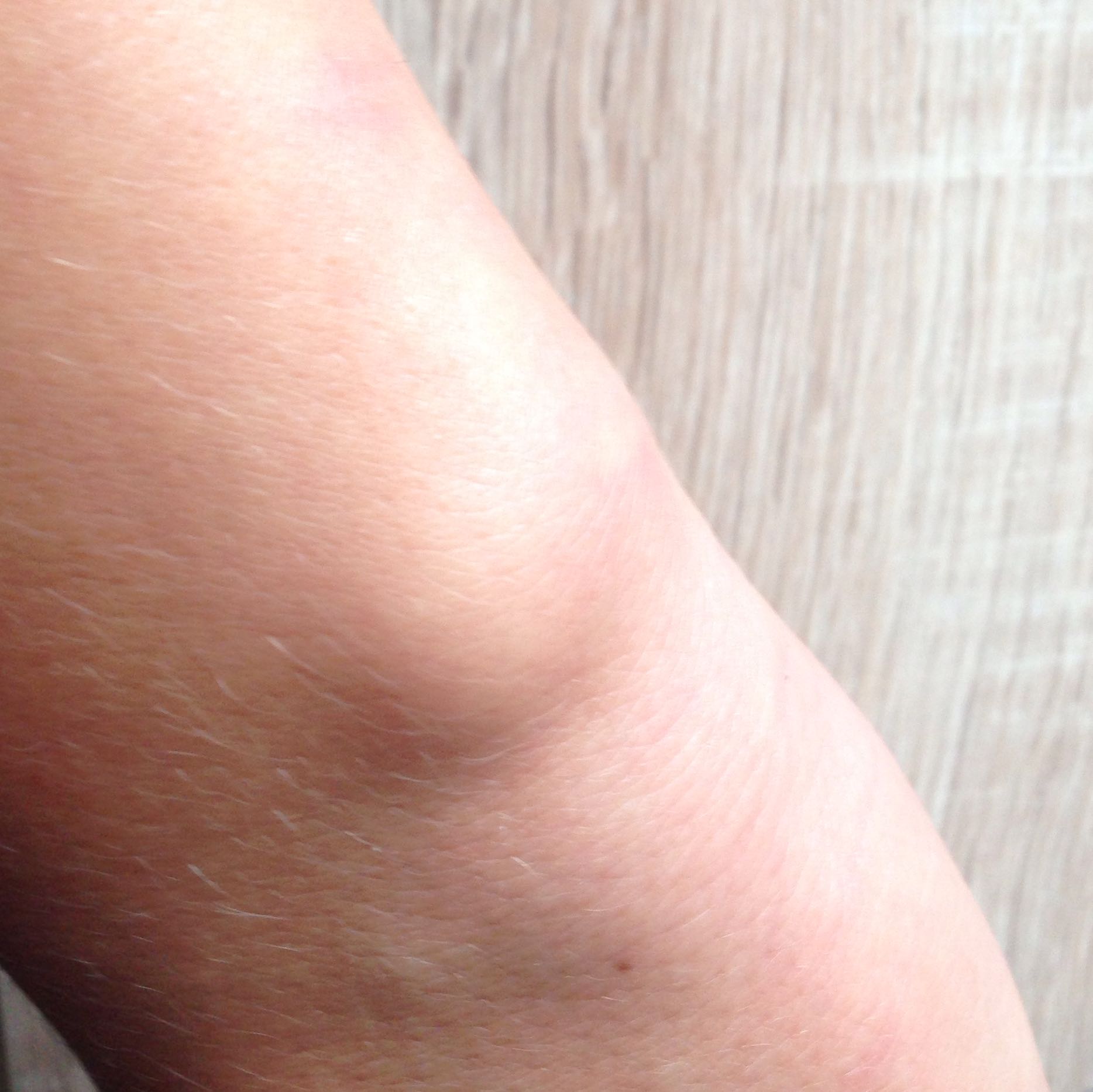 Ist Knacken ein Hinweis auf Bruch? (Schmerzen, Schwellung, Handgelenk) Ist Knacken ein Hinweis auf Bruch? (Schmerzen, Schwellung, Handgelenk)