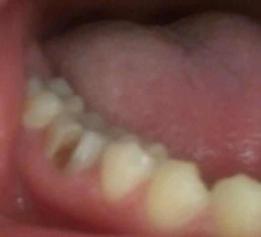 zahn loch an der seite  - (Zähne, Zahnarzt, Zahnspange)