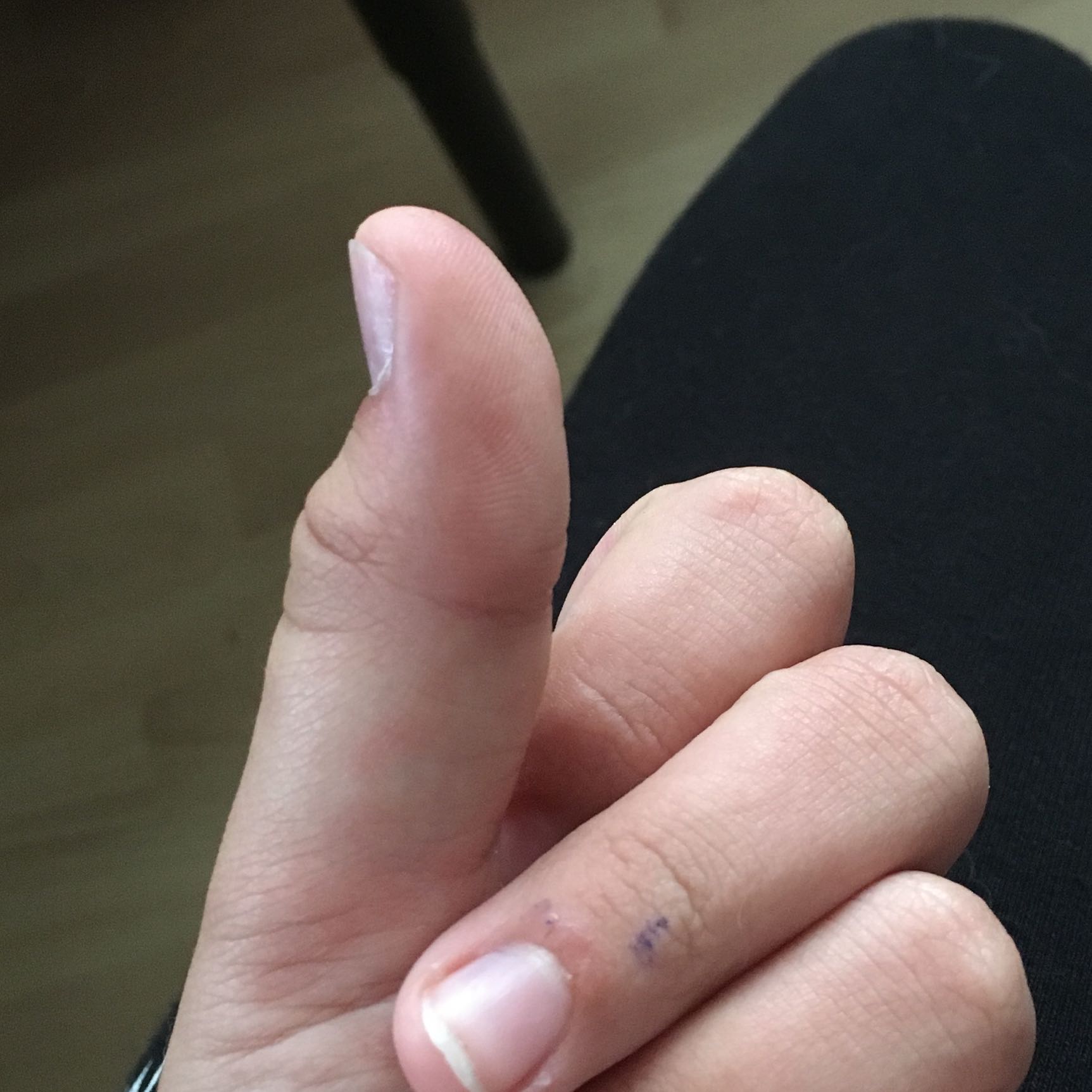 Ist mein Daumen gebrochen? Hilfe? Daumenbruch? (Medizin, Bruch)