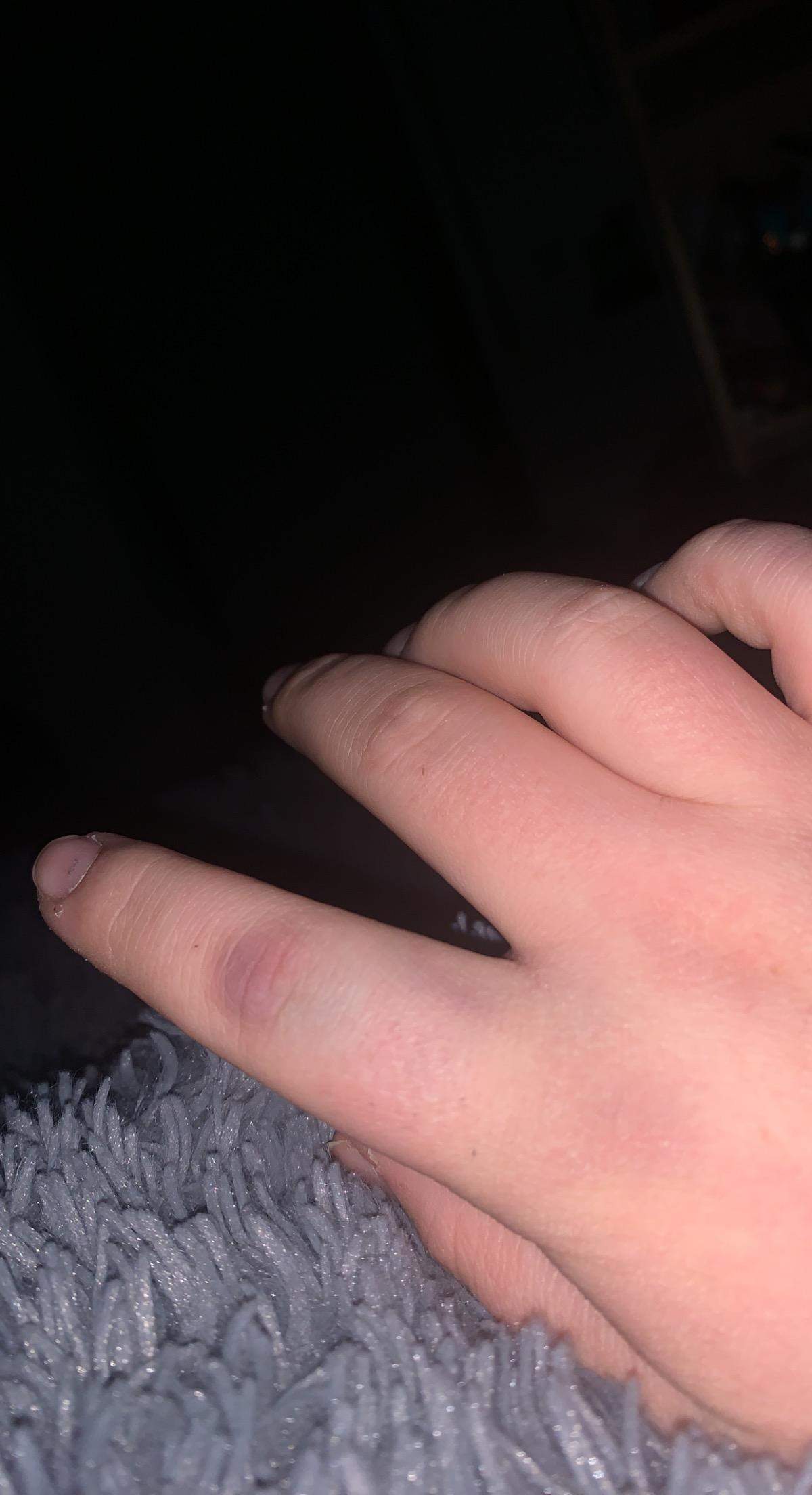 Ist mein Finger gebrochen? (Gesundheit und Medizin)