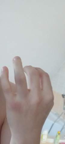 Ist mein Finger gebrochen?