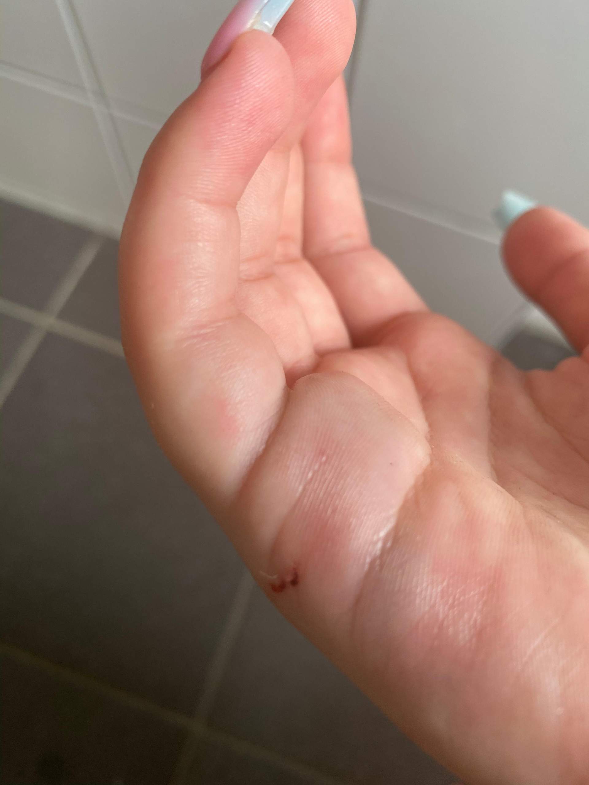 Woran Merke Ich Das Mein Finger Gebrochen Ist
