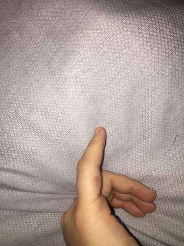 Ist Mein Finger Gebrochen Oder Nur Geprellt Gesundheit Und Medizin Bruch Fraktur