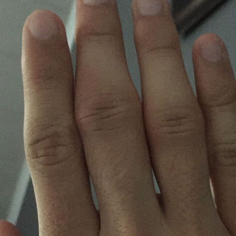 Mittelfinger - (Finger, Bruch, Chirurgie)
