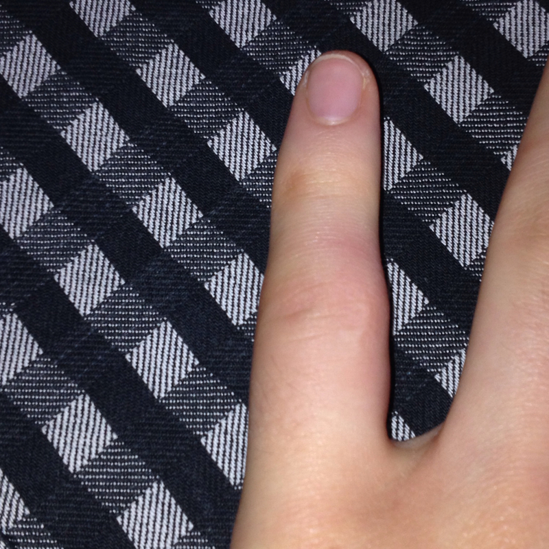 Wie Schaut Ein Gebrochener Finger Aus