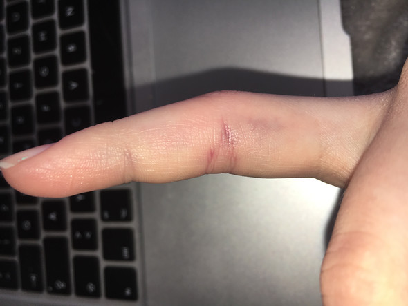Verletzter Finger - (Arzt, Verletzung)