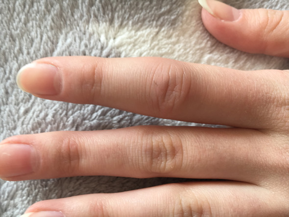 Verletzter Finger - (Arzt, Verletzung)