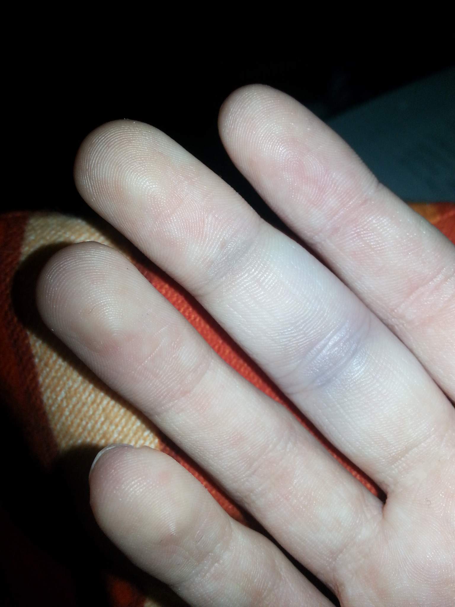 Ist mein Finger gestaucht / geprellt? (Prellung, Stauchung)