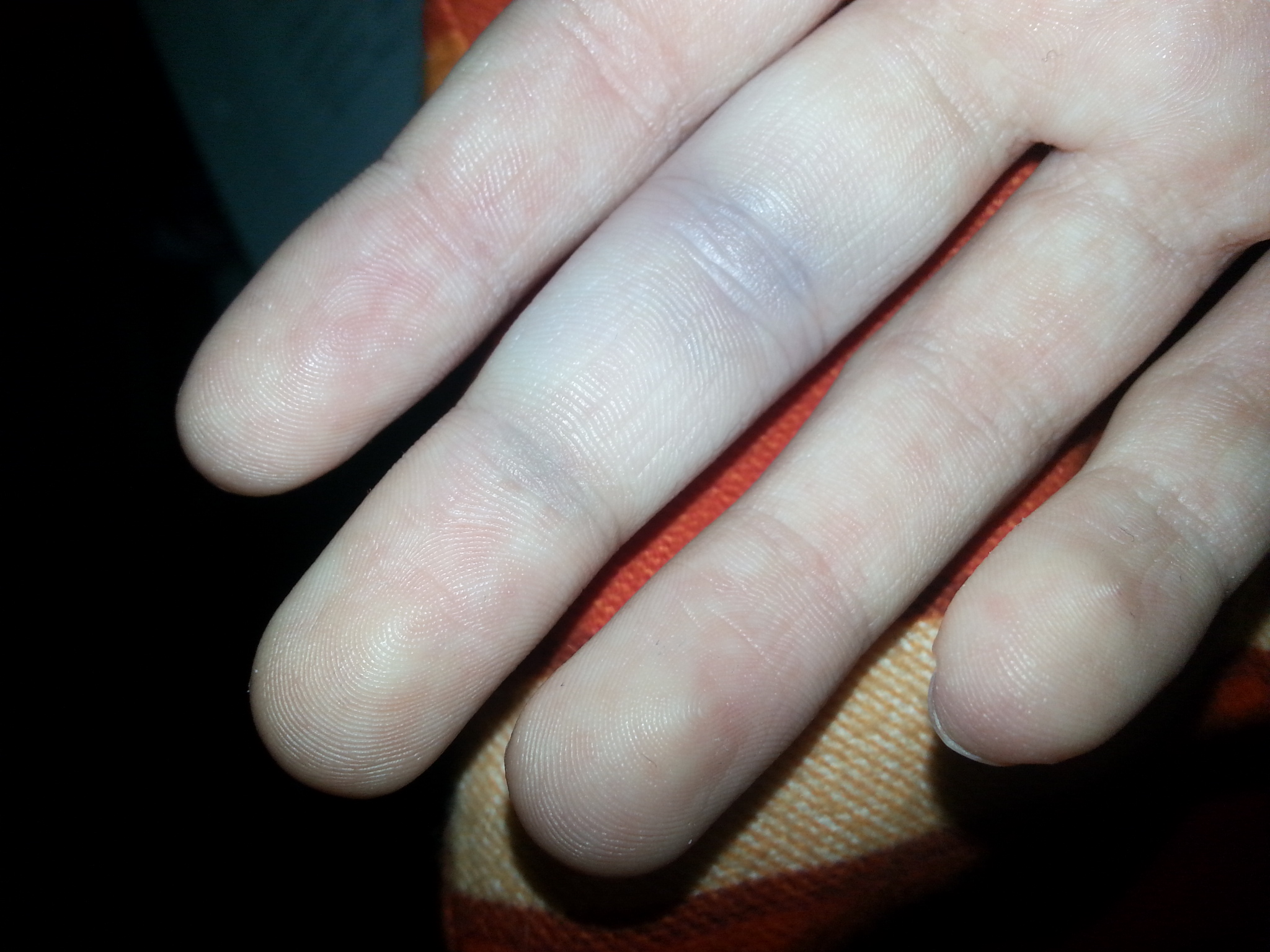 Ist mein Finger gestaucht / geprellt? (Prellung, Stauchung) Ist mein Finger gestaucht / geprellt? (Prellung, Stauchung)