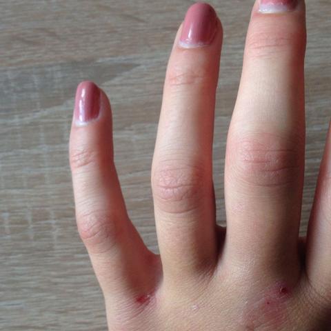 Mittelfinger  - (Hand, Finger, Bruch)