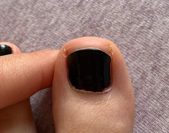 Ist Mein Fussnagel Eingewachsen Gesundheit Fusse