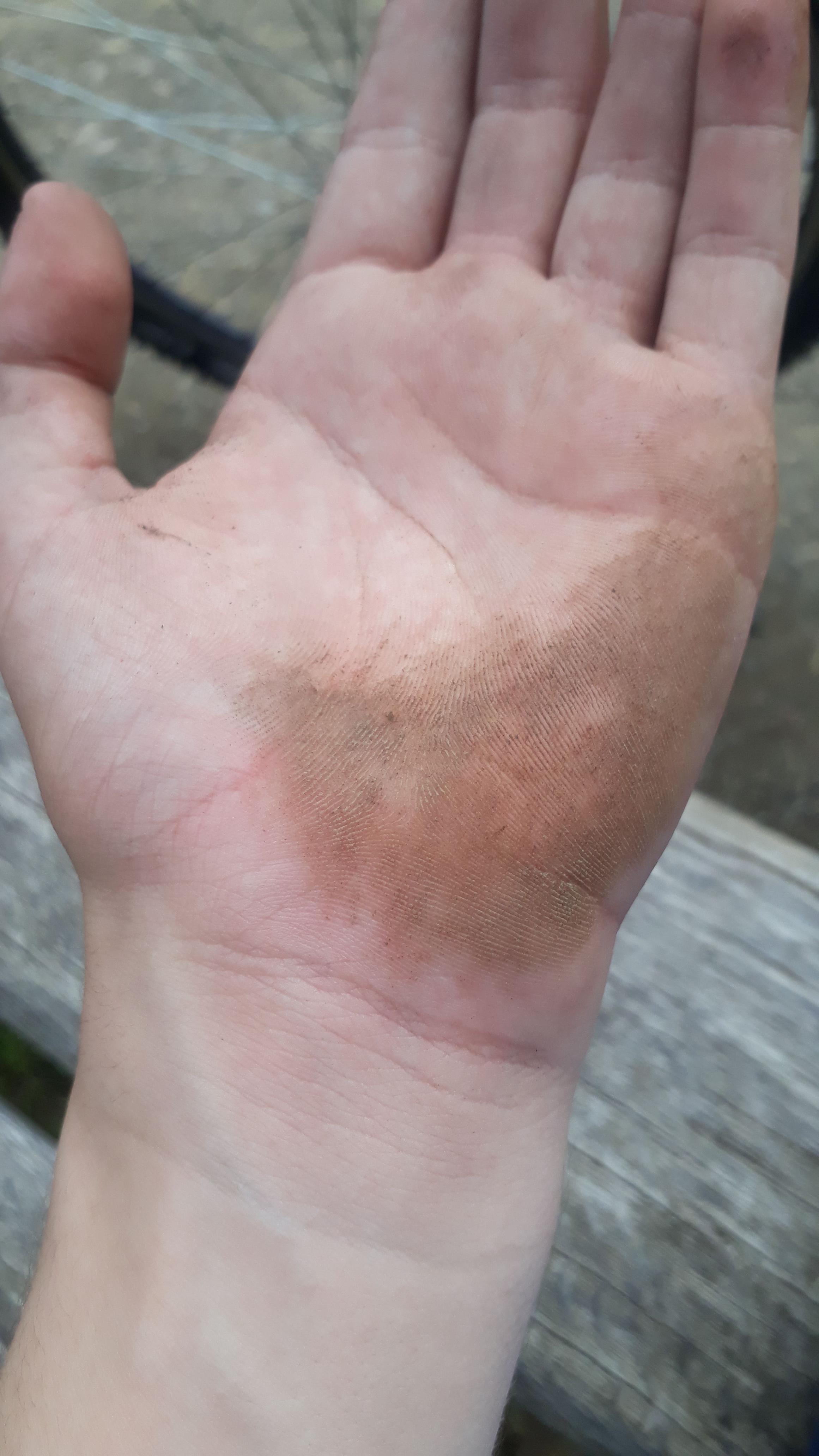 Handgelenk Gebrochen Op Mit Platte Erfahrungen