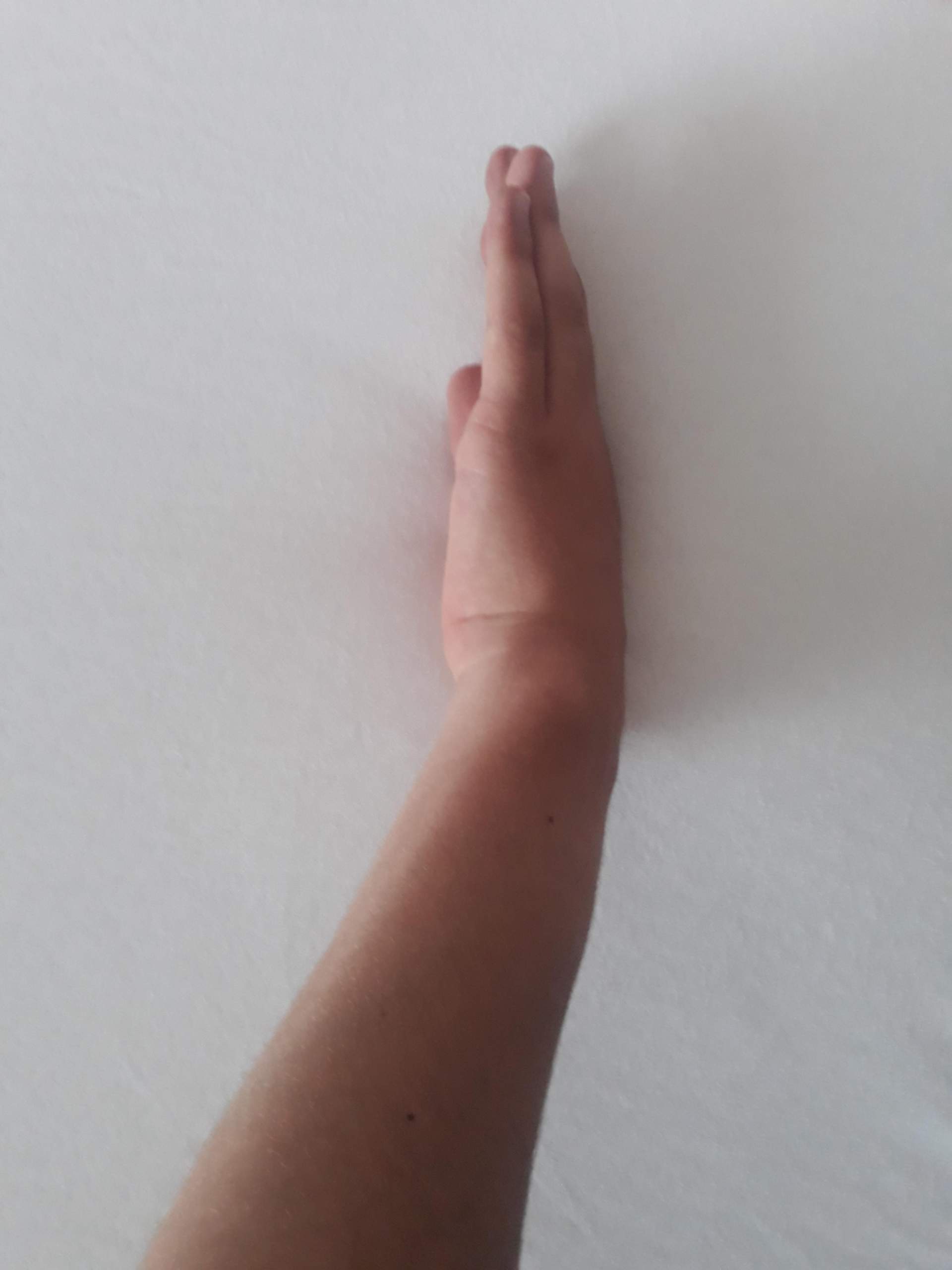 Ist mein Handgelenk gebrochen bzw.geprellt? (Gesundheit und Medizin