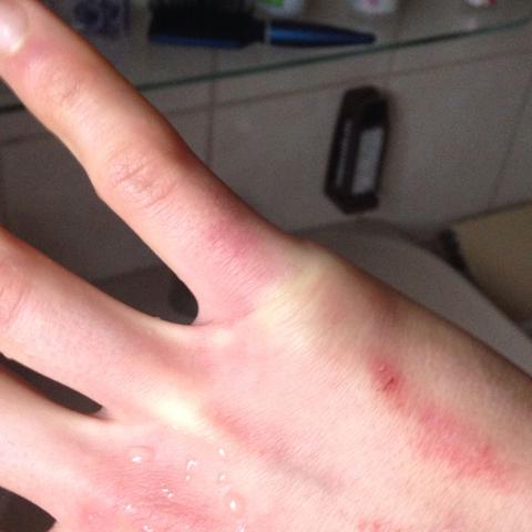 Ist Mein Kleiner Finger Gebrochen Psyche Knochen Bruch Ist Mein Kleiner Finger Gebrochen Psyche Knochen Bruch