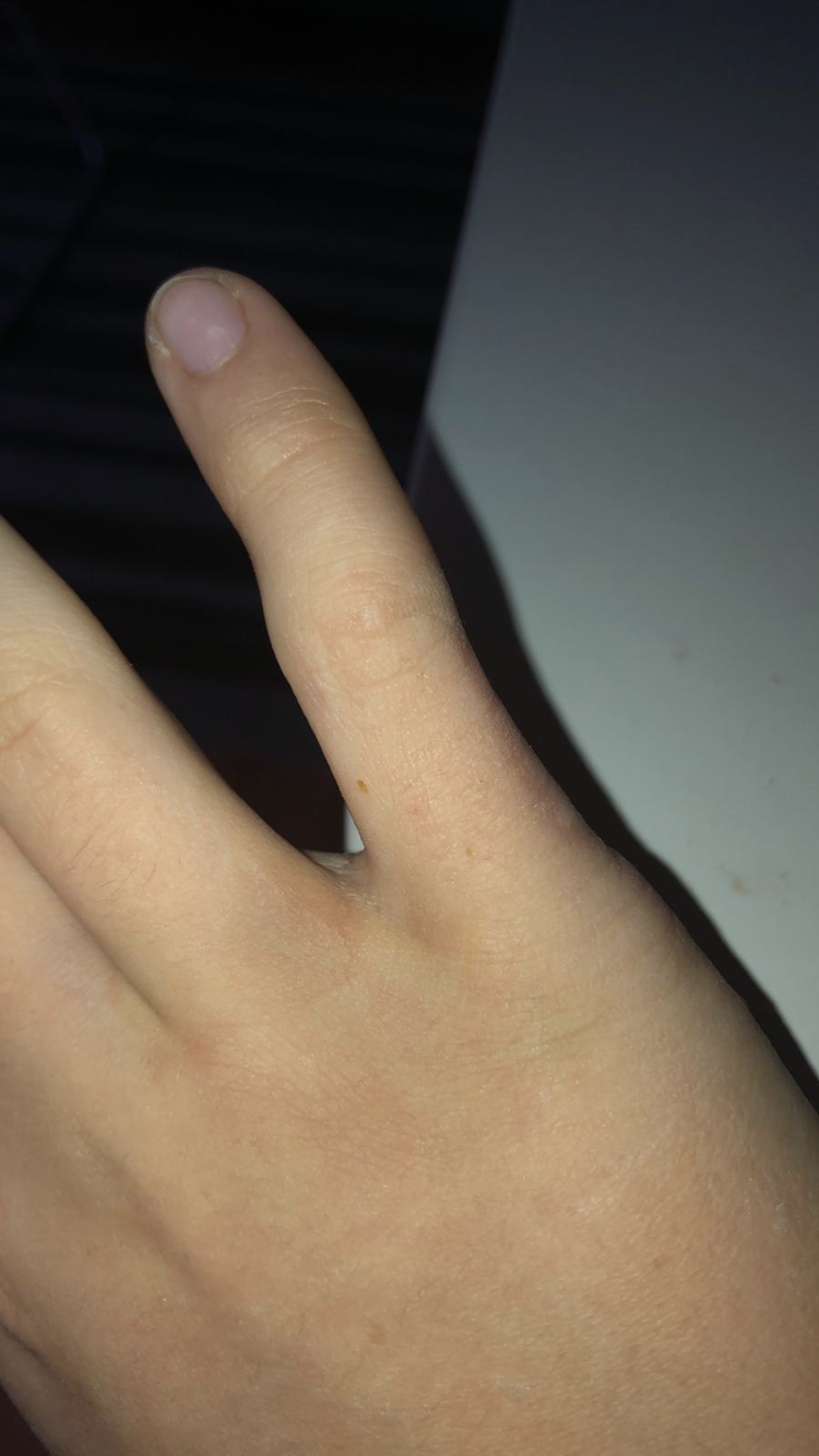 Ist Mein Kleiner Finger Verstaucht Oder Gebrochen Gesundheit Und Medizin Gesundheit Medizin