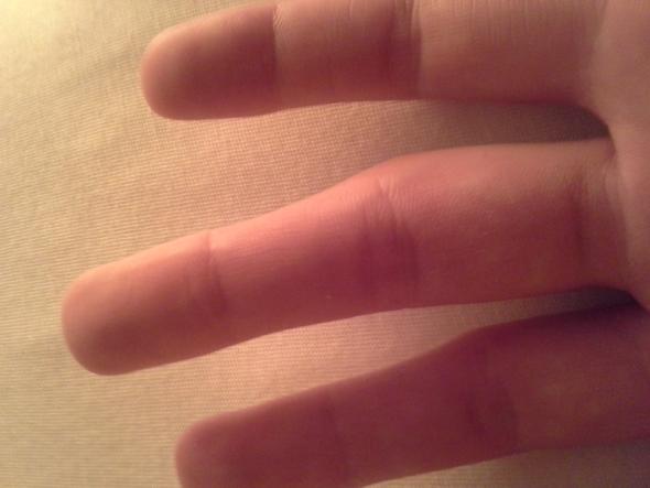 Schnell sich finger brechen kann wie den man Fingerfraktur, Heilungsdauer,