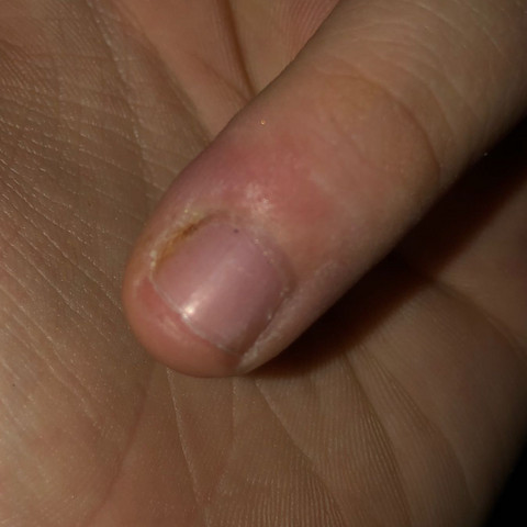 Hier ist der Finger nocheinmal genauer - (Gesundheit und Medizin, Entzündung, nagelbett)