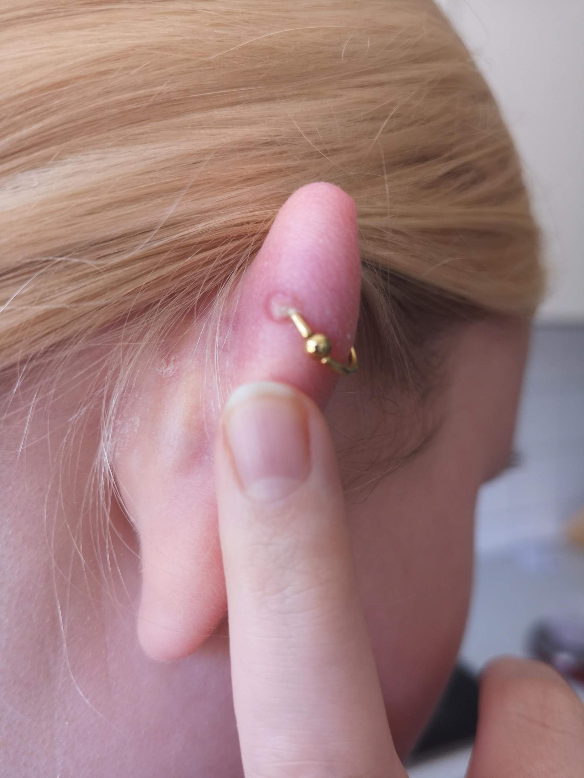 ist mein piercing entzündet? (Helix, Körperschmuck, Piercingpflege)