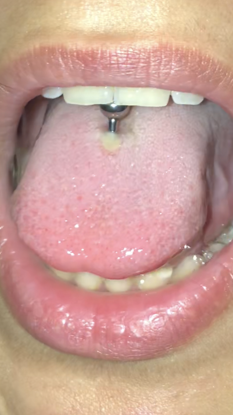 Ist Mein Piercing Irgendwie Entzundet Zungenpiercing Piercingstudio Piercing Stechen Ist Mein Piercing Irgendwie Entzundet Zungenpiercing Piercingstudio Piercing Stechen