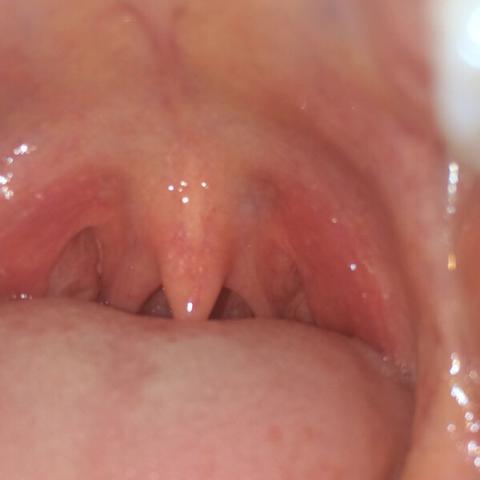 Ist Mein Rachen Rot Gesundheit Medizin Hals Ist Mein Rachen Rot Gesundheit Medizin Hals